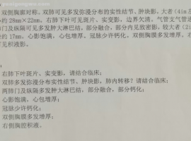 肺鳞癌单药维持1年，出现脑转，放疗后，还是单药维持的....或是消融。